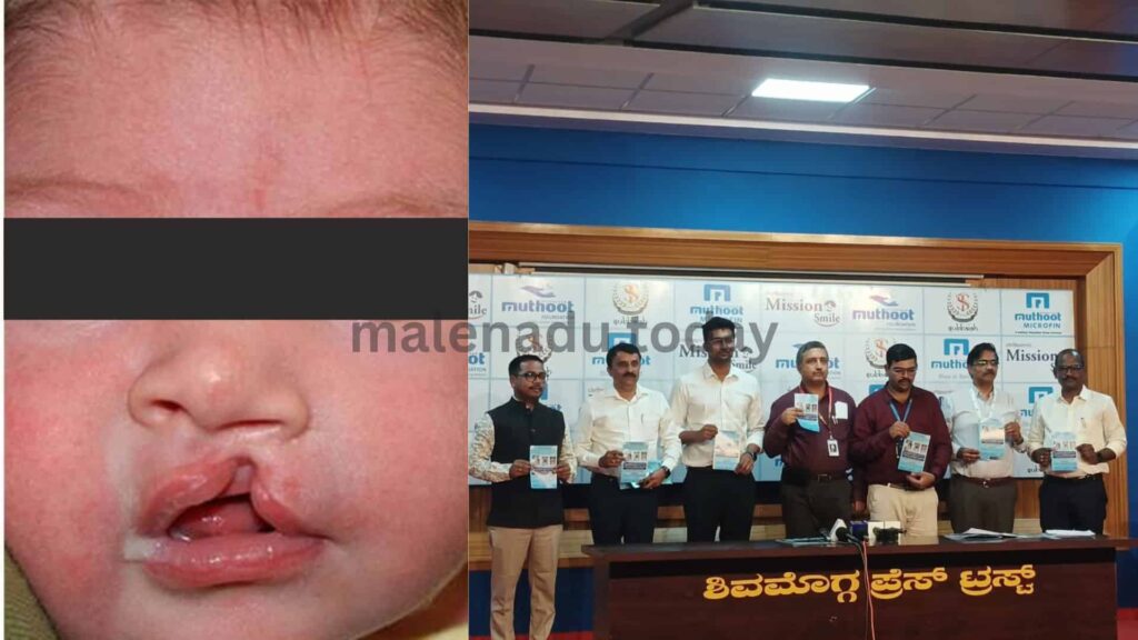 cleft lip surgery in shivmogga