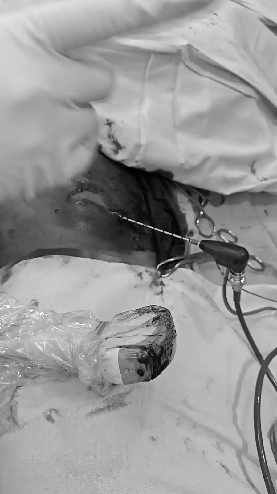 ನಂಜಪ್ಪ ಲೈಫ್ ಕೇರ್ ನಲ್ಲಿ ಮೈಕ್ರೋವೇವ್ ಅಬ್ಲೇಶನ್ ಮೂಲಕ ಆಪರೇಷನ್ ಯಶಸ್ವಿ! ವಿಶೇಷ ವಿಷಯವಿದೆ ಓದಿ! 1 Nanjappa Life Care : High-Tech Success: Shivamogga Nanjappa Life Care Cures Liver Cancer